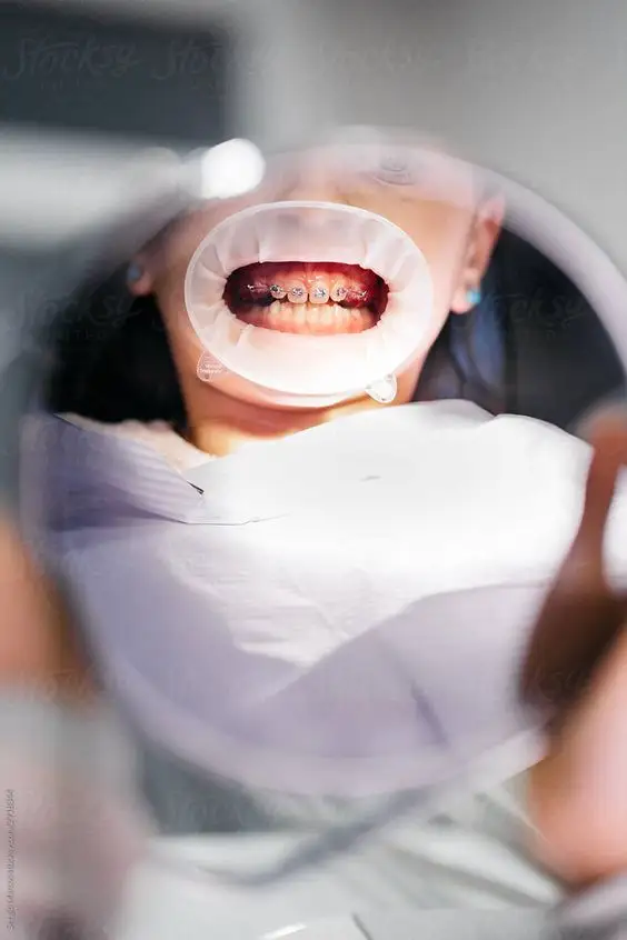 Ortodonti & Şeffaf Plak Tedavisi (Invisalign)